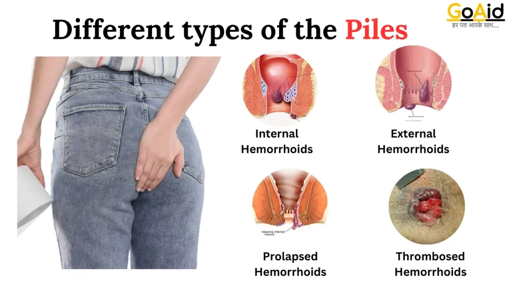 Different types of the Piles 
